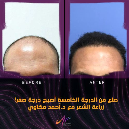 ما هي أفضل تقنية زراعة الشعر؟